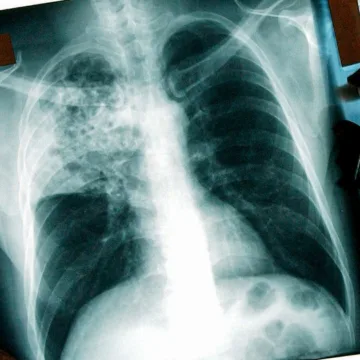 Tuberculosis outbreak that has killed 2 in Kansas grows