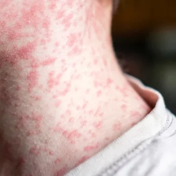 Measles cases quickly rising in Minnesota. Here’s where outbreaks are spreading in the U.S.