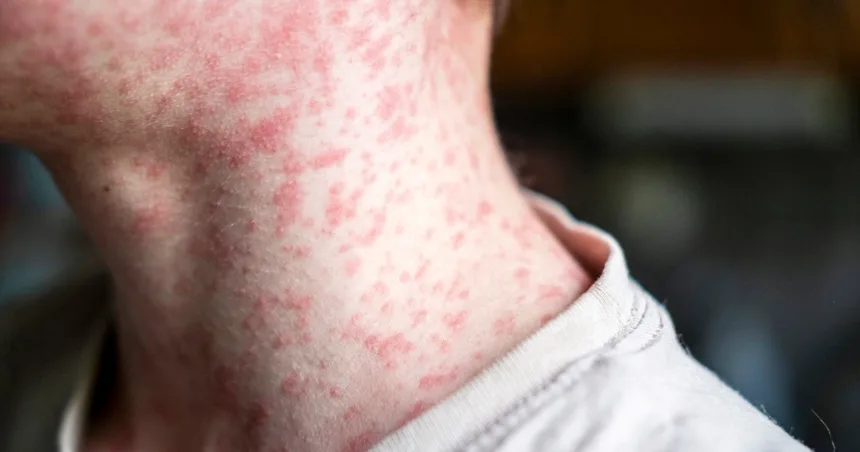 Measles cases quickly rising in Minnesota. Here’s where outbreaks are spreading in the U.S.