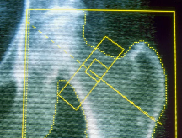 260227-BONE-DENSITY-SCAN-GK-e48c1b.jpg GLP-1s may increase risk of osteoporosis and gout, new research finds