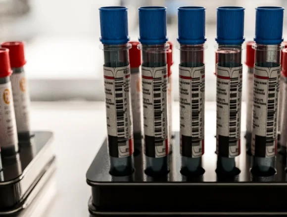 Patients say they want Alzheimer’s blood tests. Doctors aren’t sure they help.